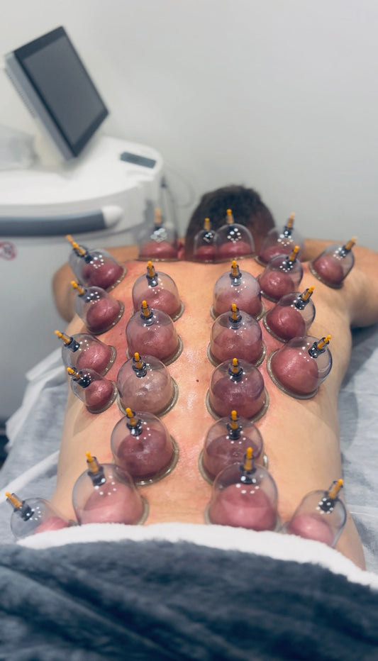 Discover the Benefits of Al-Hijama (Wet Cupping Therapy)